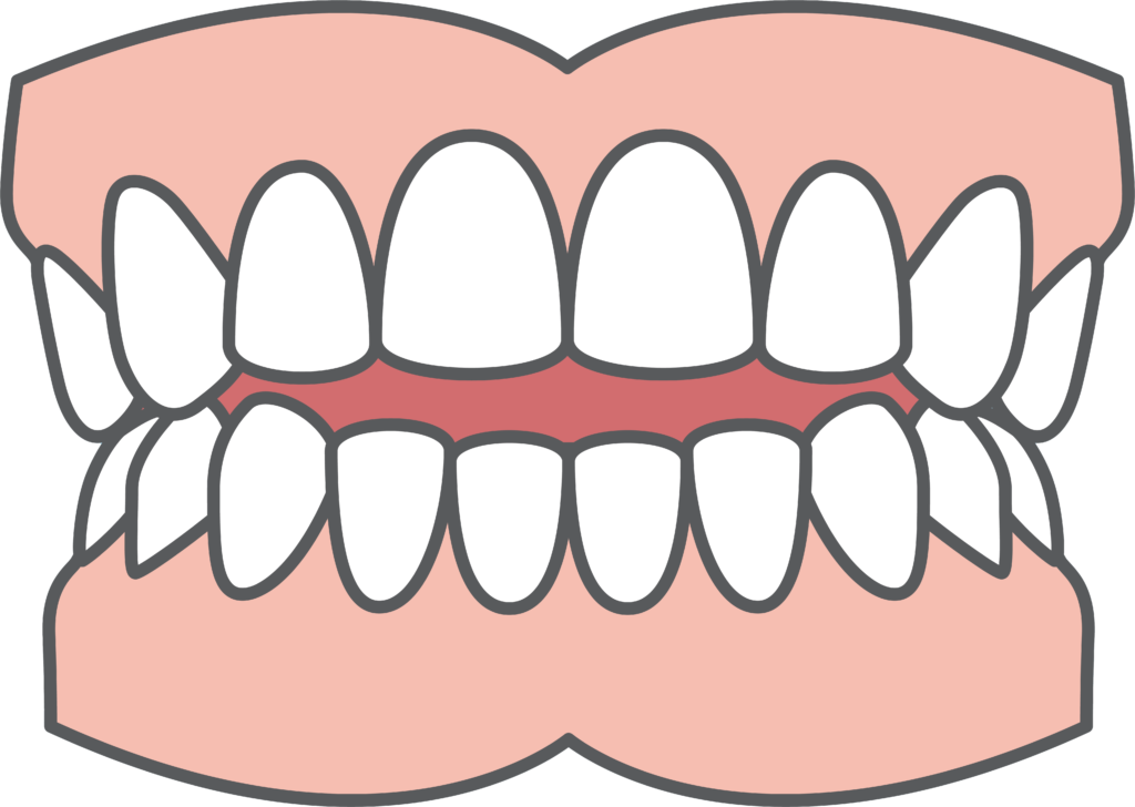 Dental Openbite Illustration