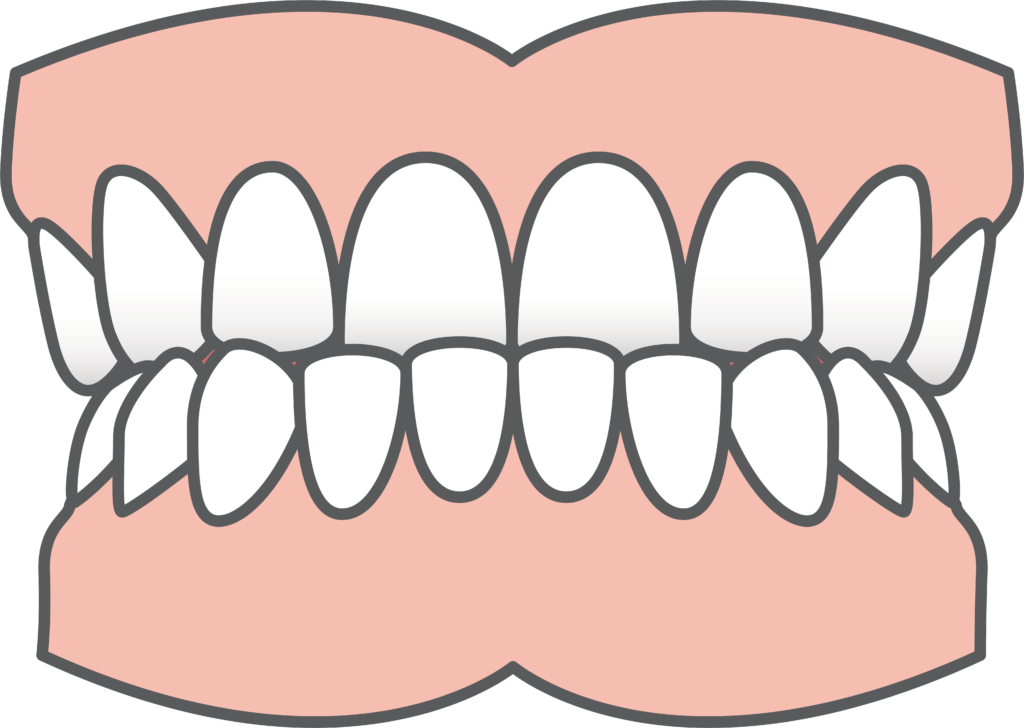 Dental Underbite Illustration