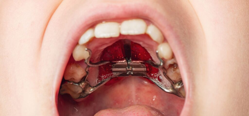Types of Palatal Expanders